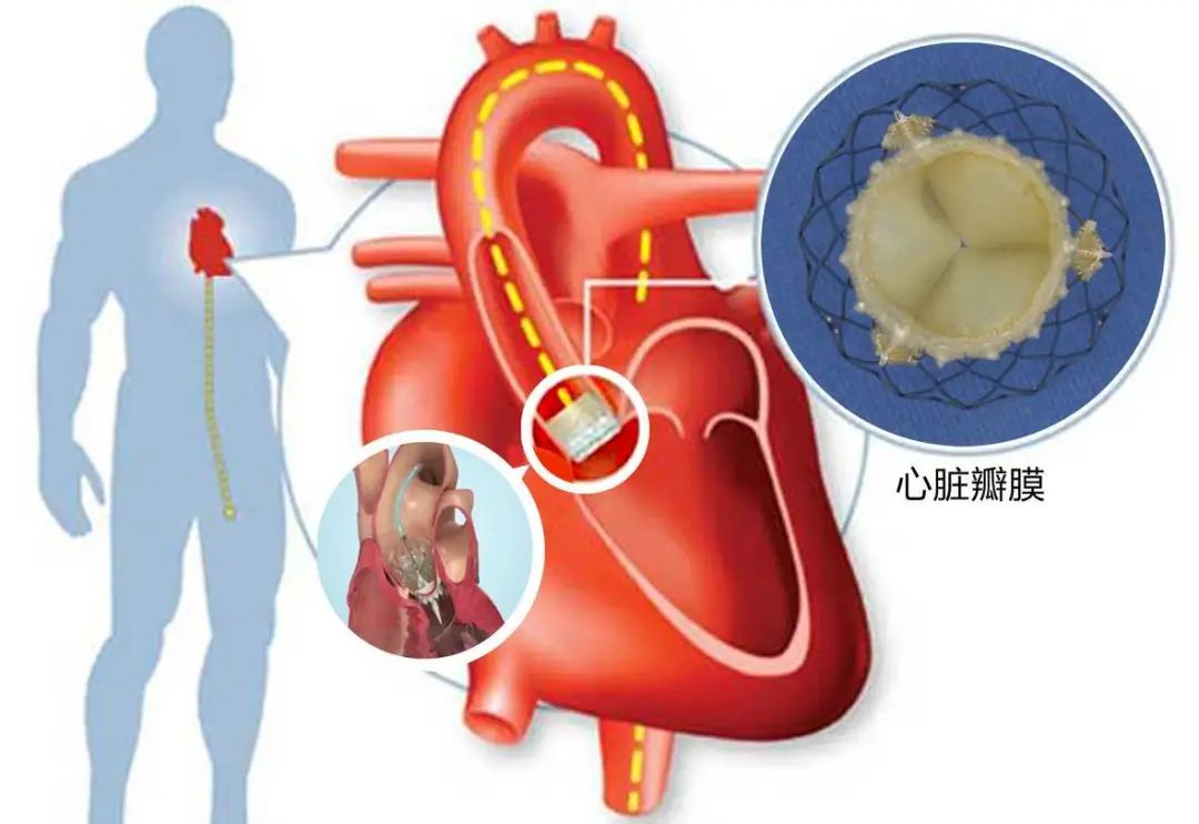 最新生物瓣技术，重塑心脏健康的未来